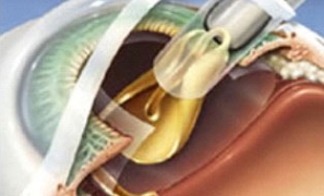 Lente intraocular sendo implantada dentro do saco capsular, substituindo o cristalino natural